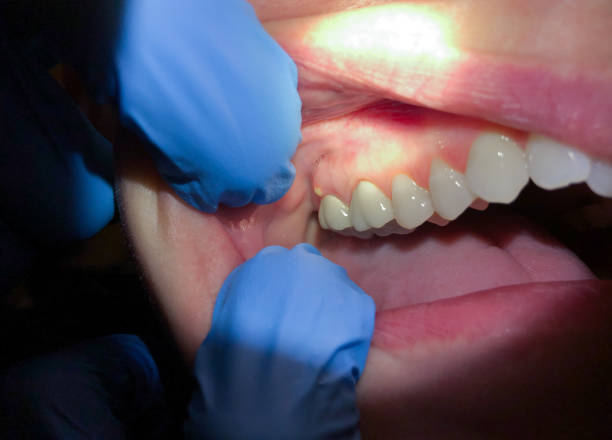 Best Emergency Dentist for Knocked-Out Tooth in Eagle, CO
